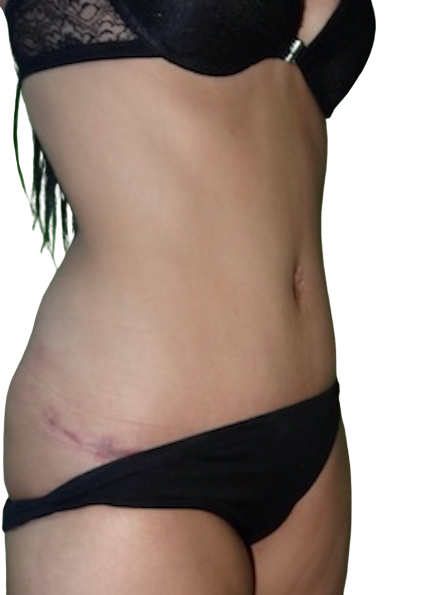 Después - Abdominoplastia