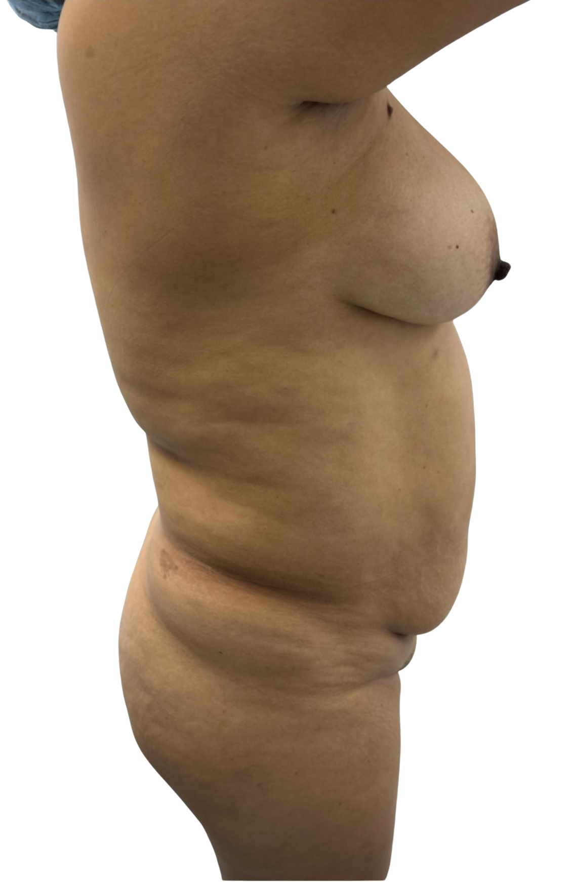 Antes - Lipoescultura