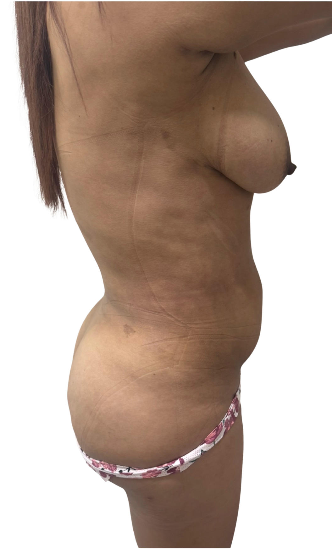 Después - Lipoescultura