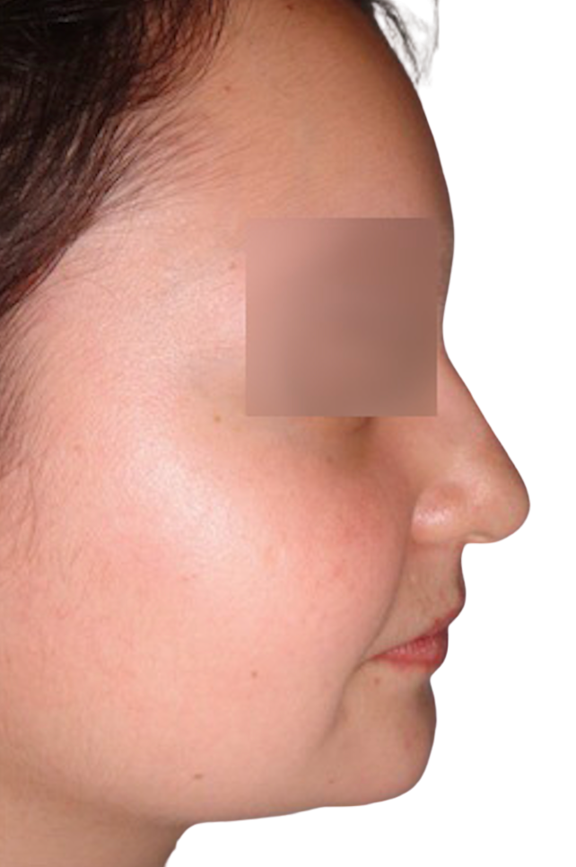 Antes - Rinoplastia