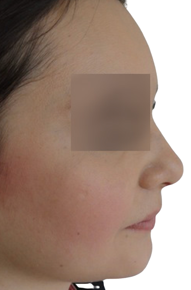 Después - Rinoplastia